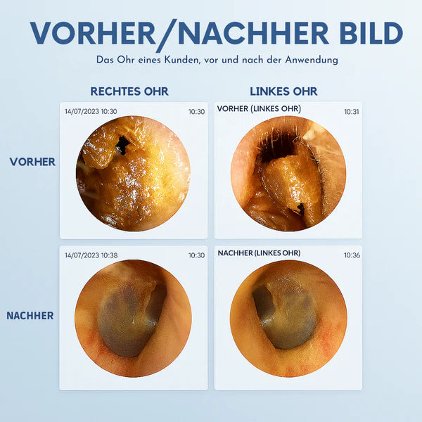 WaxFree™ – Smarte Ohrreinigung